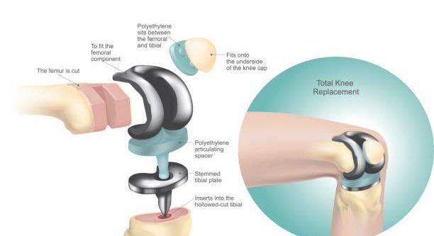 Knee replacement surgery Knee replacement surgery, also called knee arthroplasty, involves replacing damaged or worn parts of the knee joint with artificial components made of metal and plastic.