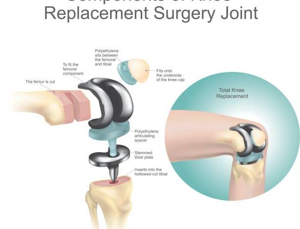 Knee replacement surgery, also called knee arthroplasty, involves replacing damaged or worn parts of the knee joint with artificial components made of metal and plastic.