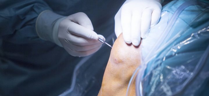 CSOG-Meniscus-Tear-Surgery