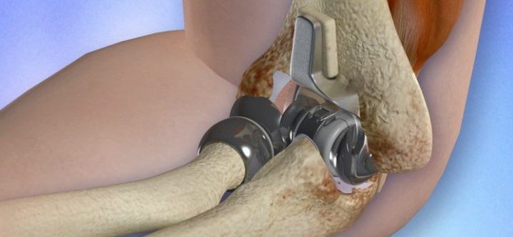 Elbow-Replacement-Surgery-what-to-know-about-it