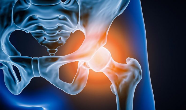 Hip-Replacement-Surgery-Dubai