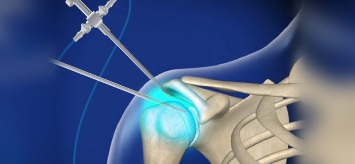 diagnosticarthroshoulder_1280