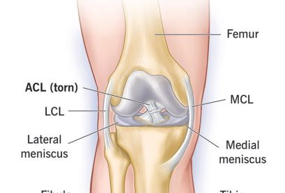 16576-acl-tear