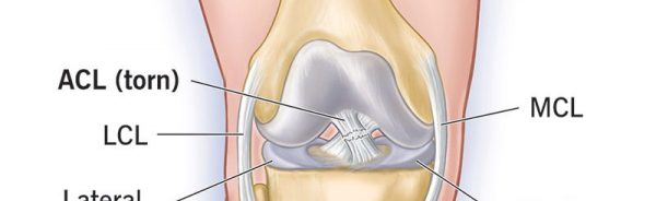 16576-acl-tear