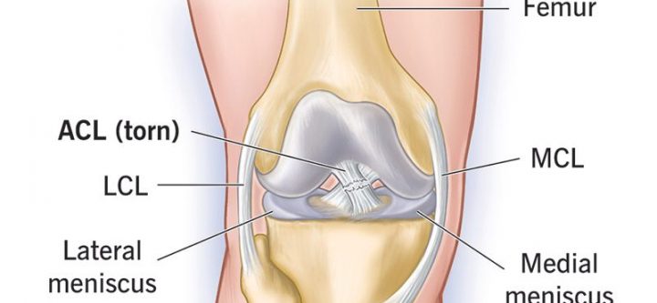 16576-acl-tear 16576-acl-tear