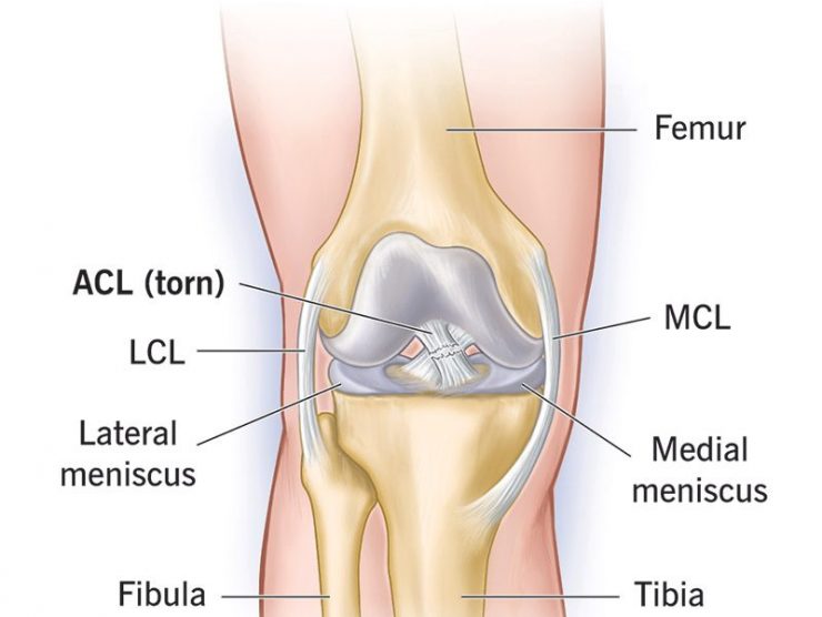 16576-acl-tear