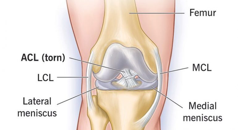 16576-acl-tear