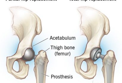 hip-replacement-surgery