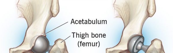 hip-replacement-surgery