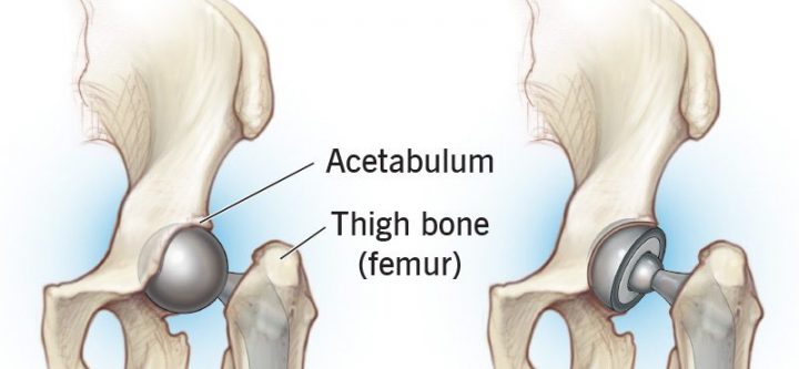hip-replacement-surgery hip-replacement-surgery