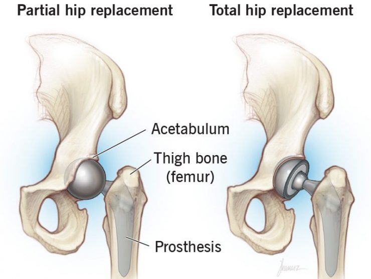 hip-replacement-surgery