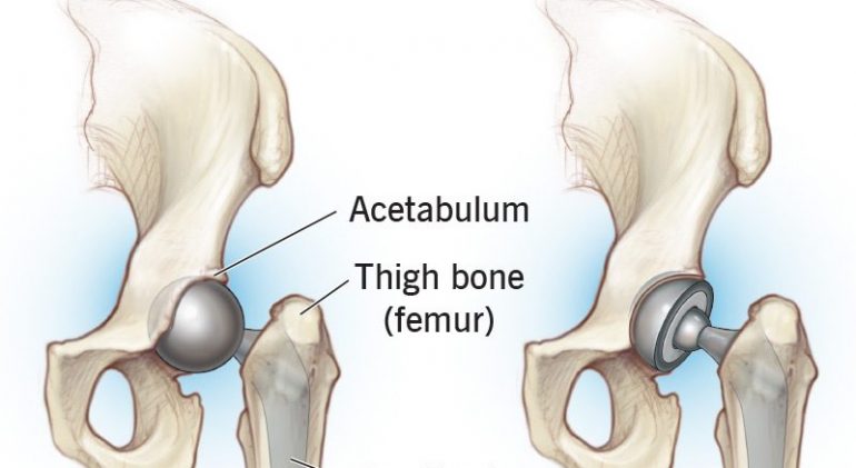 hip-replacement-surgery
