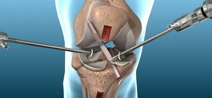 ACL Reconstruction 1 ACL Reconstruction 1