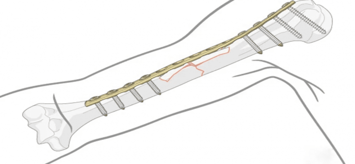 Kinds-of-Modes-of-Bone-Plating