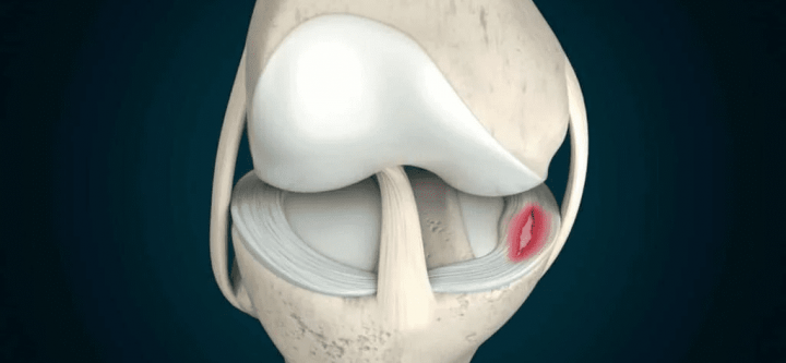 Meniscus-Repair Meniscus-Repair