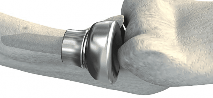 Radial-head-replacement