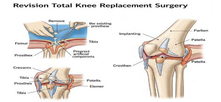 Revision-total-knee-replacement-surgery
