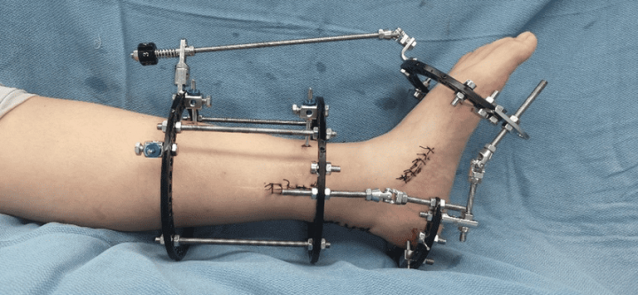 The-Ilizarov-external-fixator-was-fixed-with-two-full-rings-around-the-tibia-and-two-half
