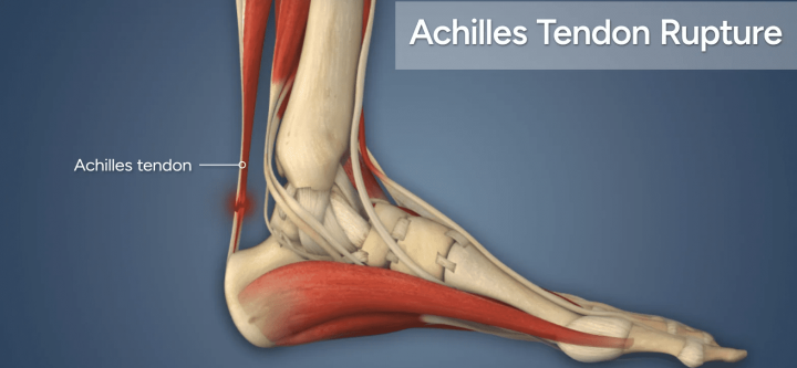 achilles-tendon-rupture-2
