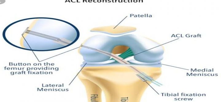 acl revision