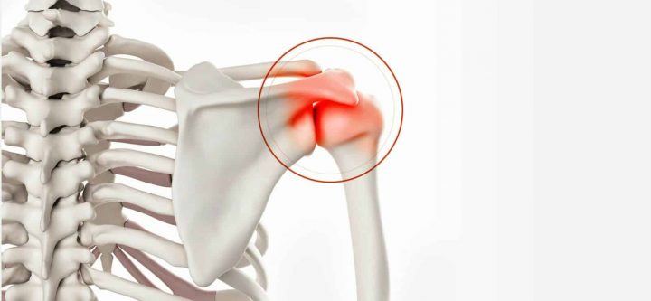 acromioplastie-de-lepaule-dr-philippe-paillard