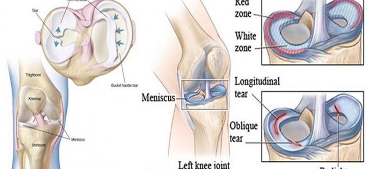 knee-meniscus-tear-diagrams-cristian-nita