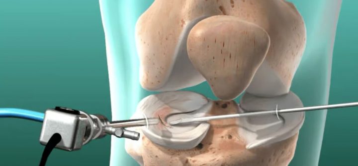 menisctomy menisctomy