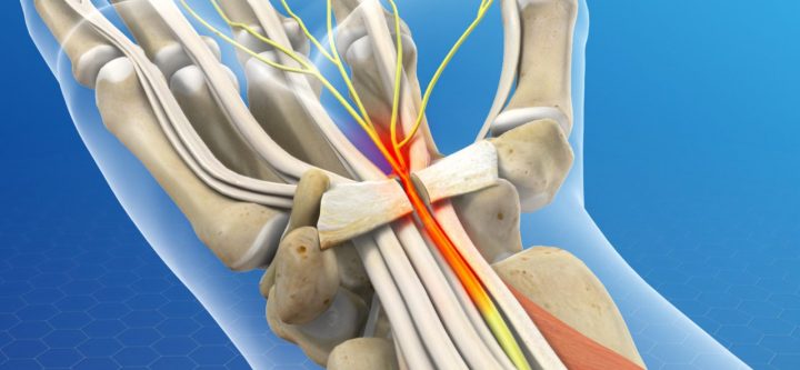 opencarpaltunnel_1280