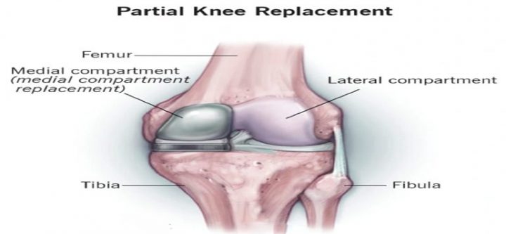 partial-knee-replacement