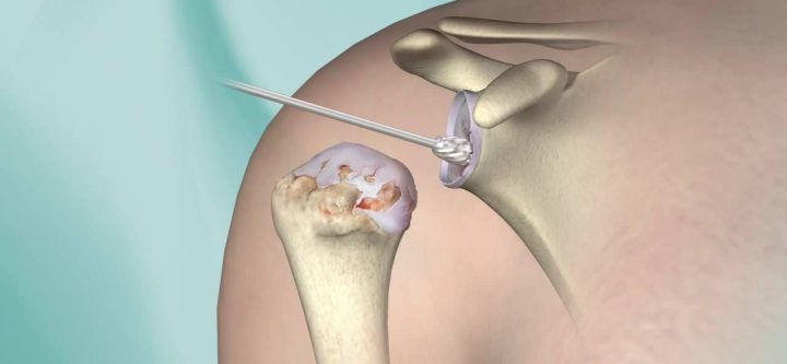 partial-shoulder-replacement