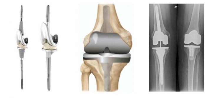 revision-knee-replacement-min