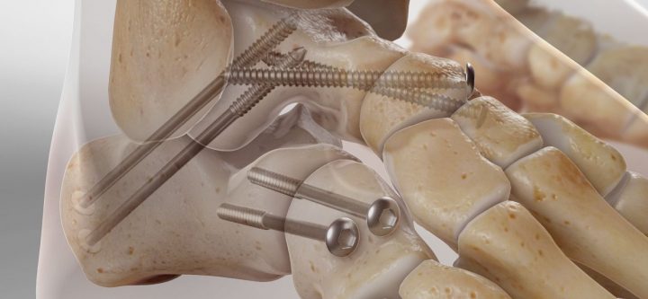 triplearthrodesis_1280