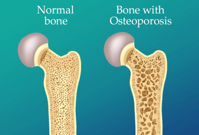 osteoporosis osteoporosis