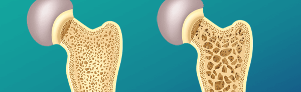 osteoporosis