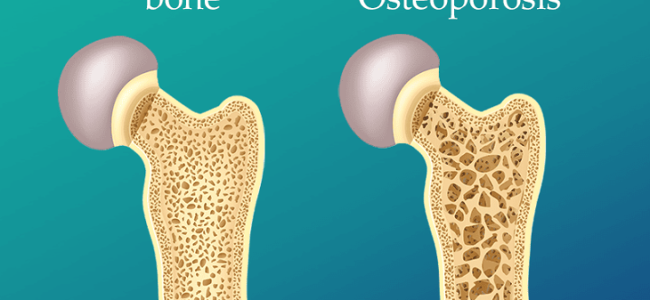 osteoporosis