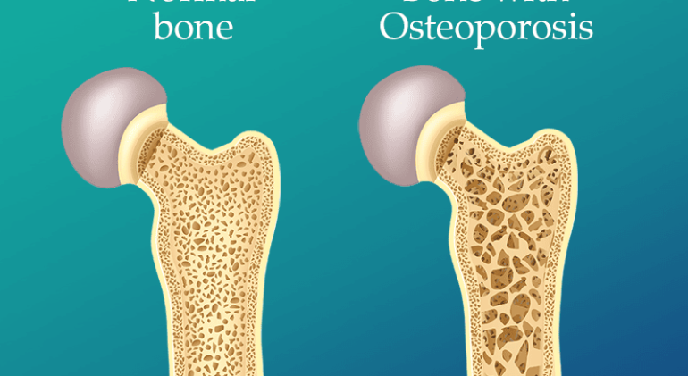 osteoporosis